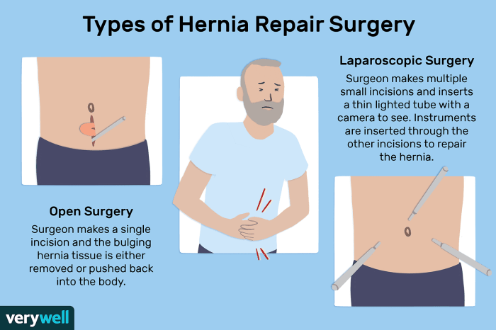 Inguinal hernia mcvay bassini femoral epomedicine